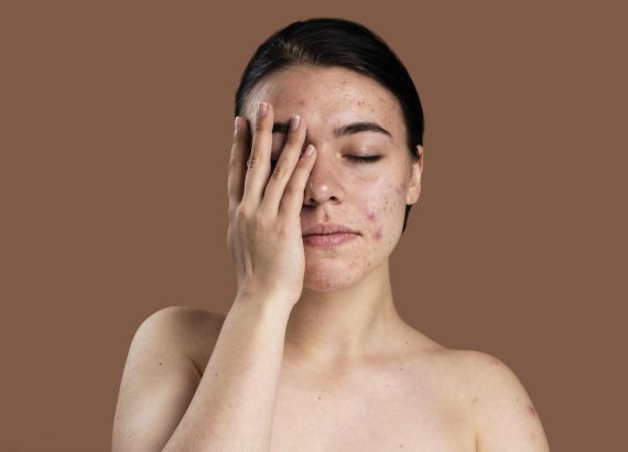 Acne behandeling