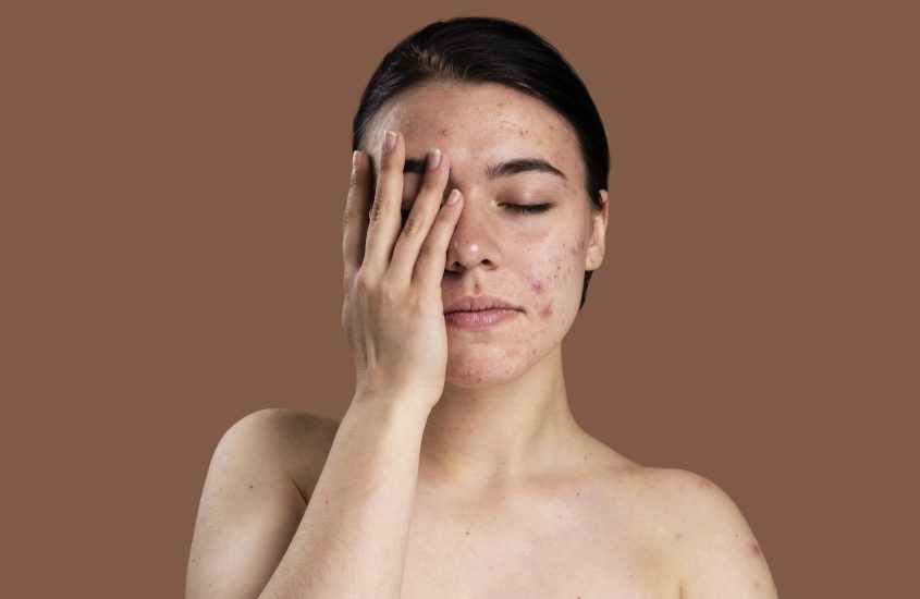 Acne en stress: hoe balans in lichaam en geest je huid verandert